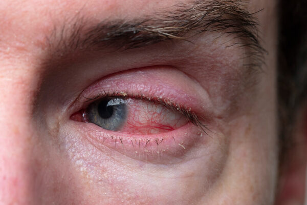 blepharitis-garden-grove-eye-inflammation-orange-county-ca